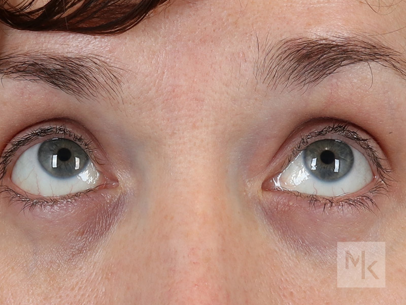 Lower Blepharoplasty Before and After | Dr. Michael Kim