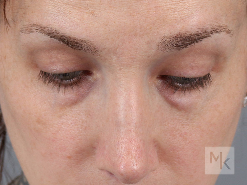 Lower Blepharoplasty Before and After | Dr. Michael Kim