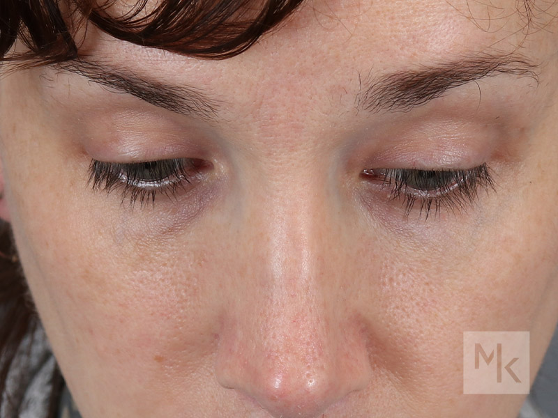 Lower Blepharoplasty Before and After | Dr. Michael Kim