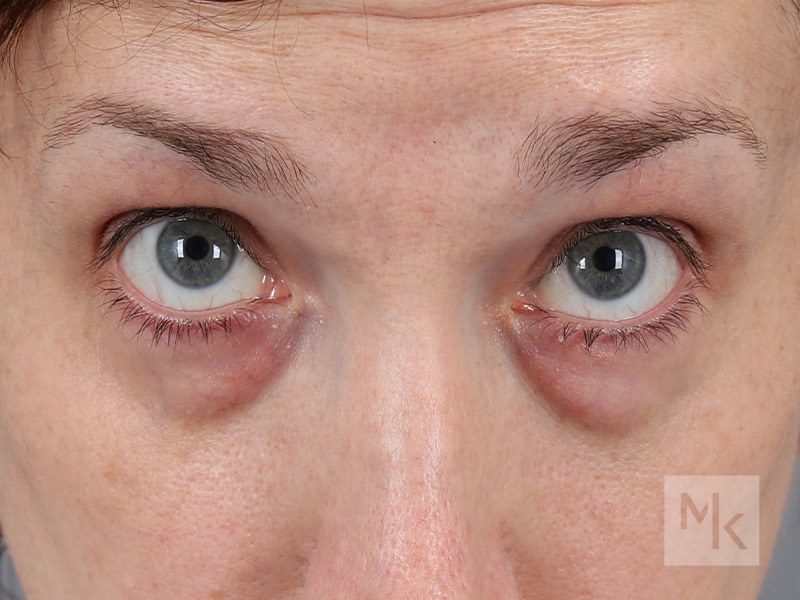 Lower Blepharoplasty Before and After | Dr. Michael Kim