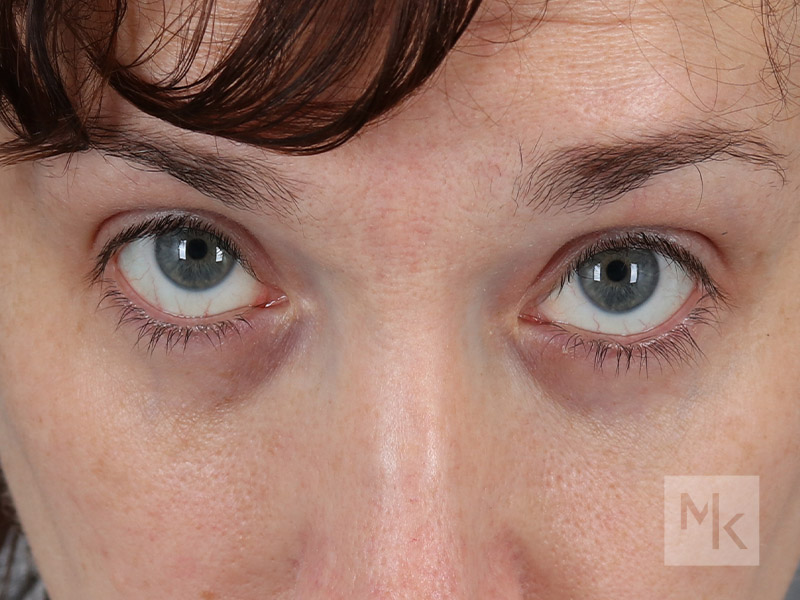 Lower Blepharoplasty Before and After | Dr. Michael Kim