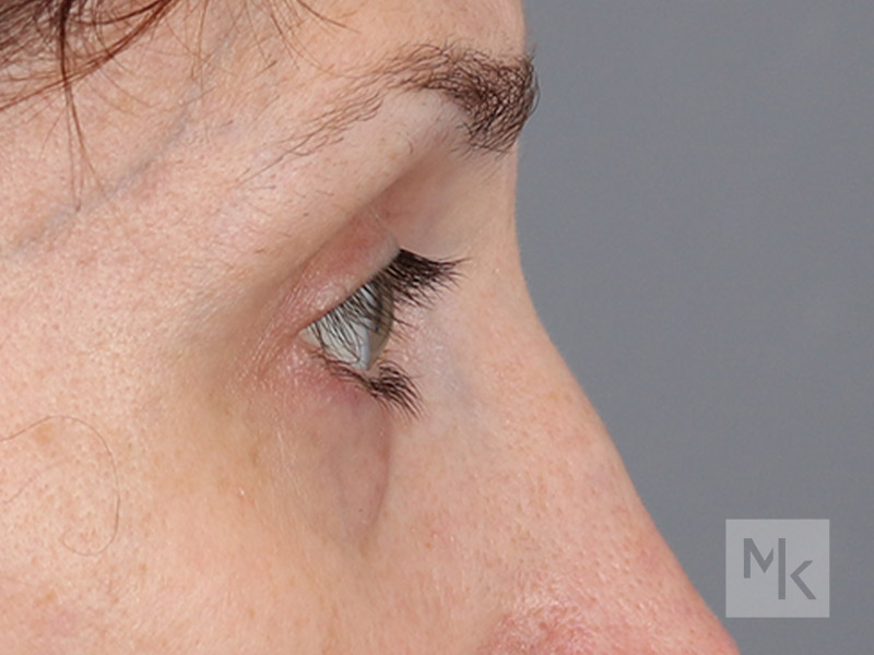 Lower Blepharoplasty Before and After | Dr. Michael Kim