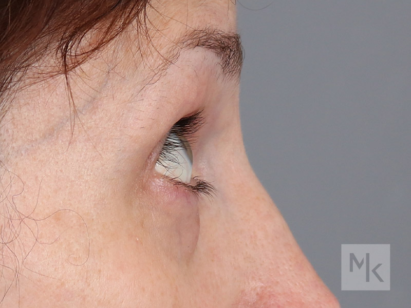 Lower Blepharoplasty Before and After | Dr. Michael Kim