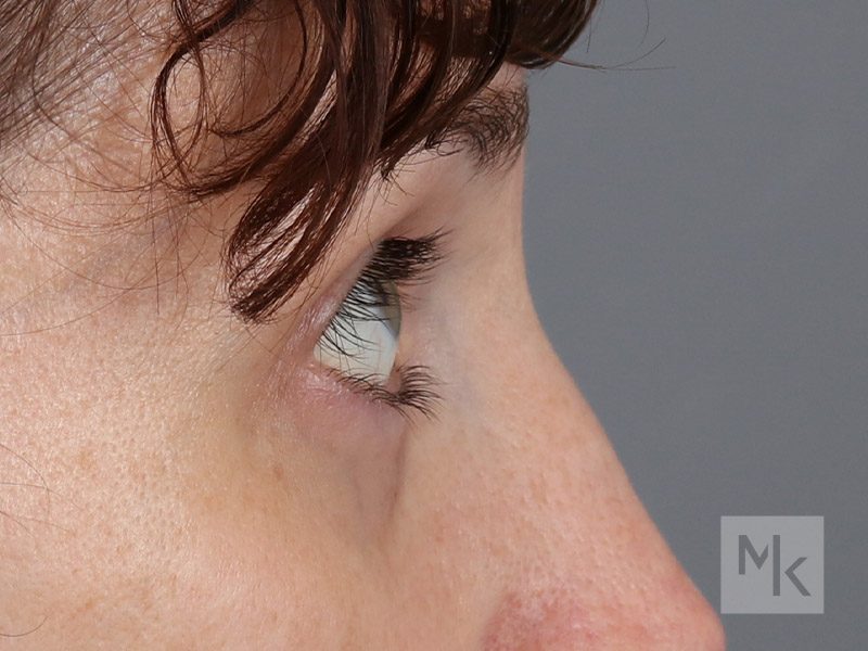 Lower Blepharoplasty Before and After | Dr. Michael Kim