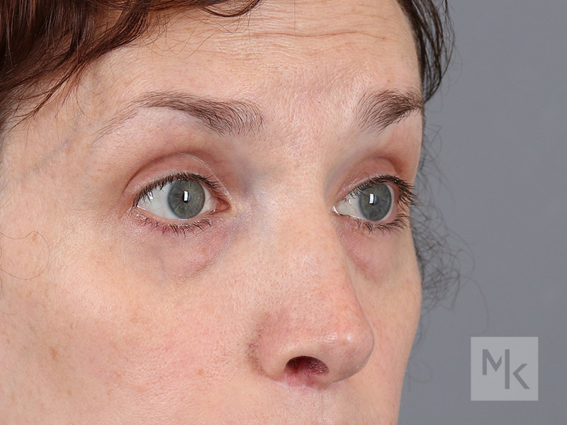 Lower Blepharoplasty Before and After | Dr. Michael Kim