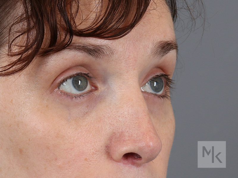 Lower Blepharoplasty Before and After | Dr. Michael Kim