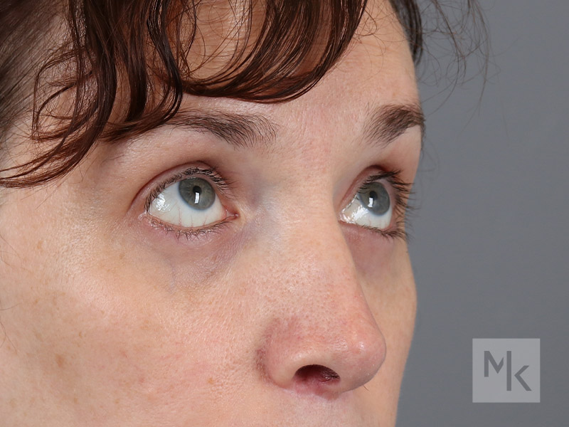 Lower Blepharoplasty Before and After | Dr. Michael Kim