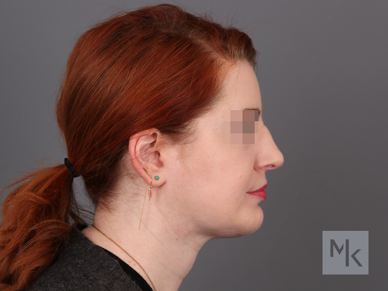 Neck Lift Before and After | Dr. Michael Kim