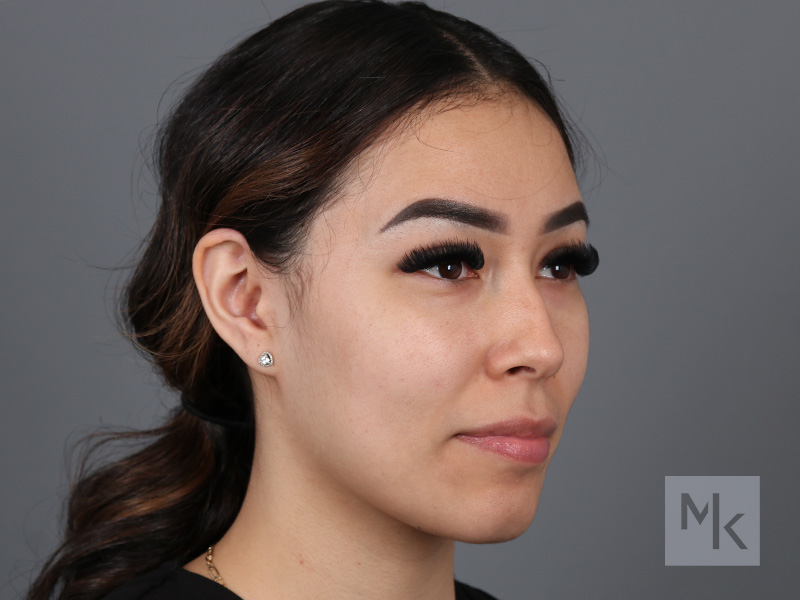 Non Surgical Rhinoplasty Before and After | Dr. Michael Kim