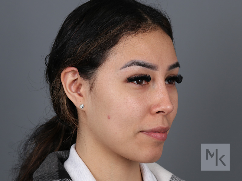 Non Surgical Rhinoplasty Before and After | Dr. Michael Kim