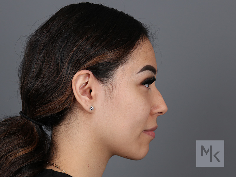 Non Surgical Rhinoplasty Before and After | Dr. Michael Kim