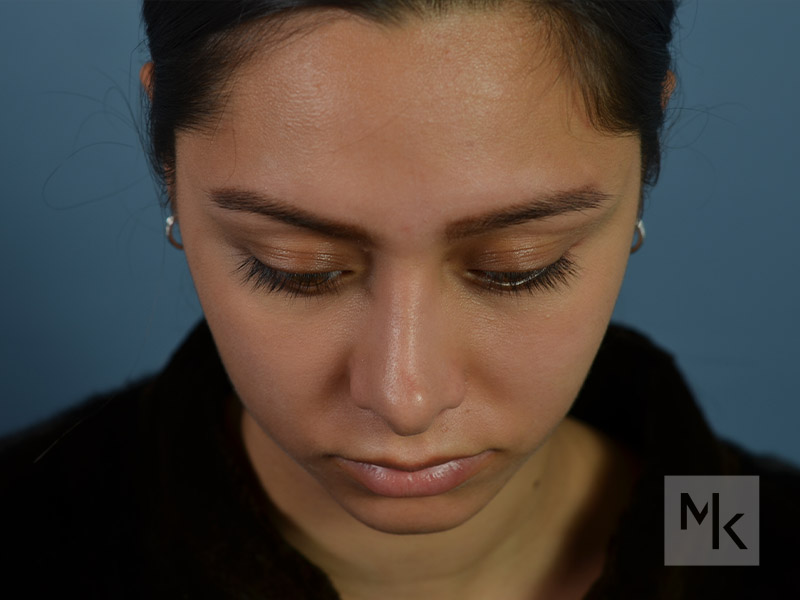 Rhinoplasty Revision Before and After | Dr. Michael Kim