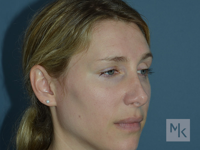 Rhinoplasty Revision Before and After | Dr. Michael Kim