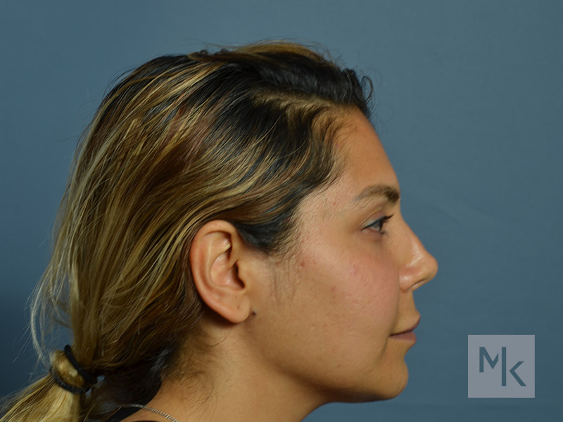 Rhinoplasty Revision Before and After | Dr. Michael Kim