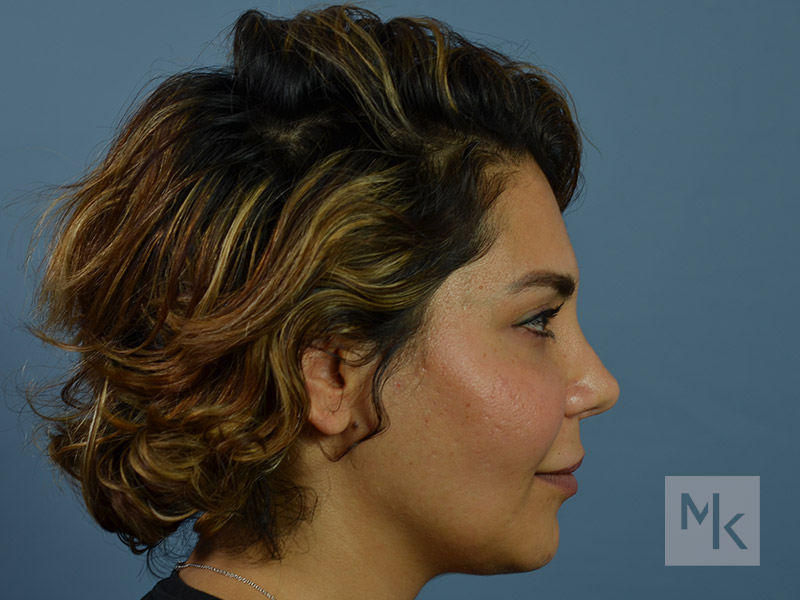 Rhinoplasty Revision Before and After | Dr. Michael Kim