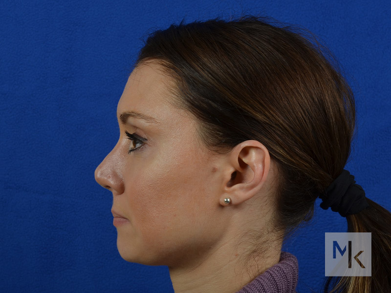 Rhinoplasty Revision Before and After | Dr. Michael Kim