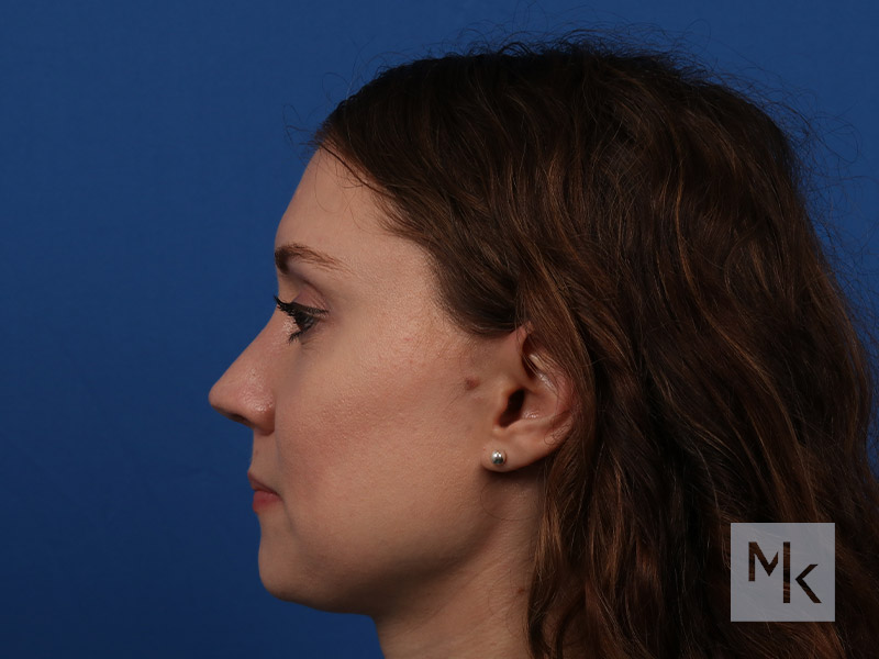 Rhinoplasty Revision Before and After | Dr. Michael Kim