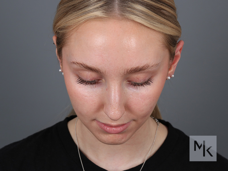 Rhinoplasty Before and After | Dr. Michael Kim