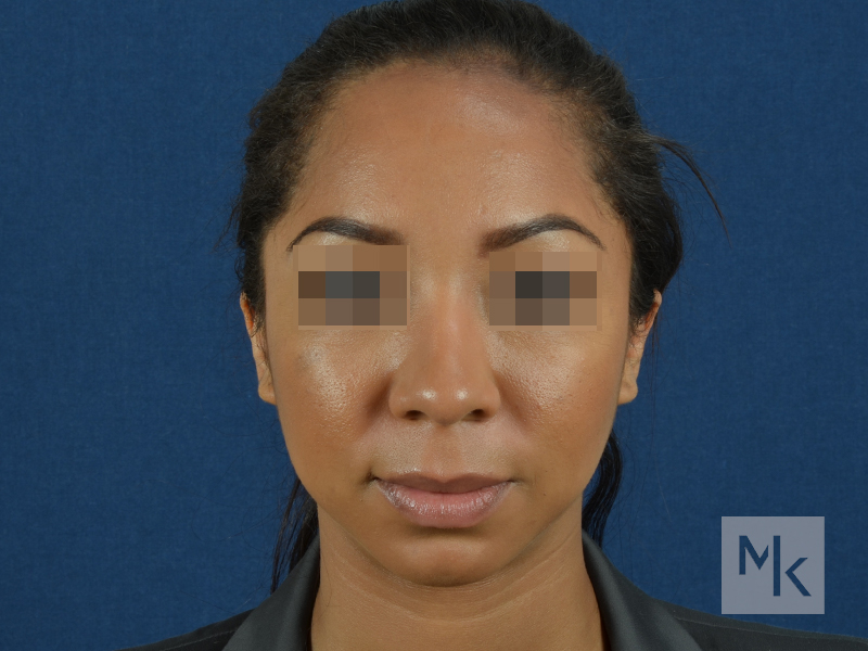 Rhinoplasty Before and After | Dr. Michael Kim