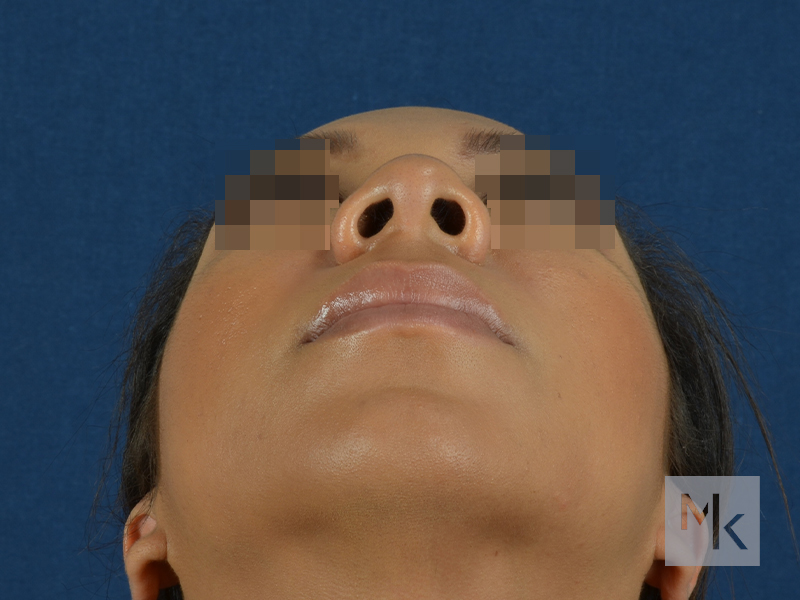 Rhinoplasty Before and After | Dr. Michael Kim