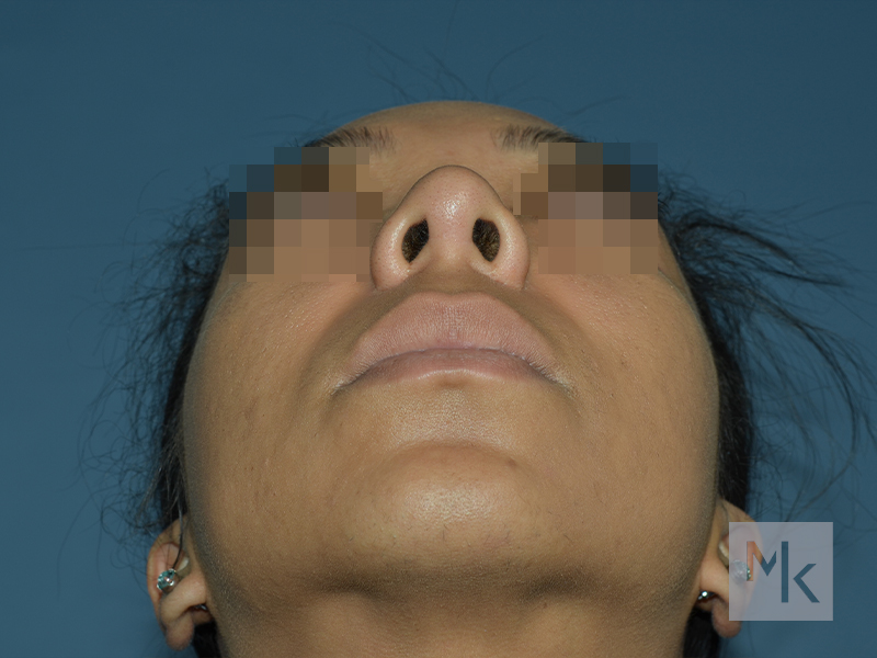 Rhinoplasty Before and After | Dr. Michael Kim