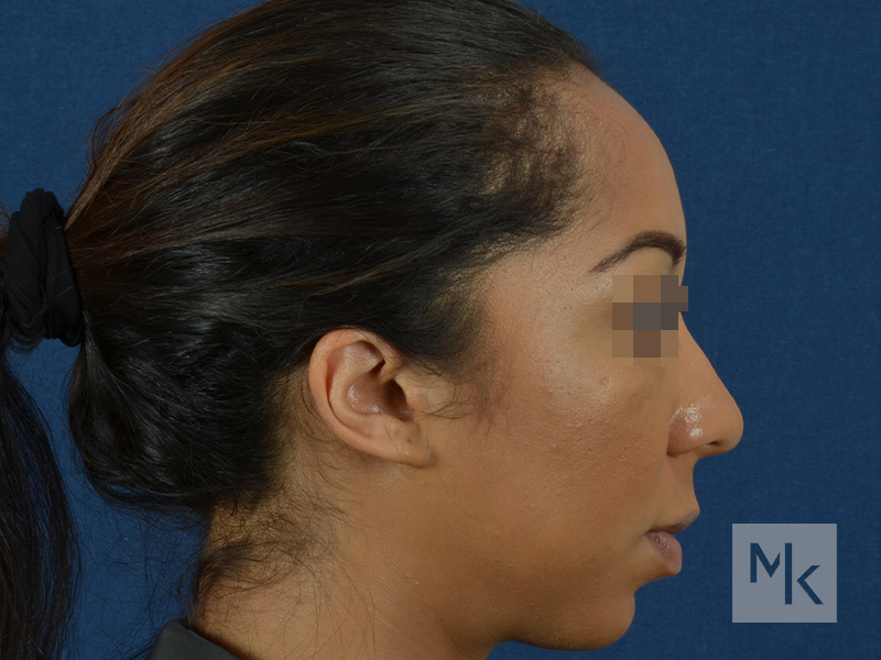 Rhinoplasty Before and After | Dr. Michael Kim