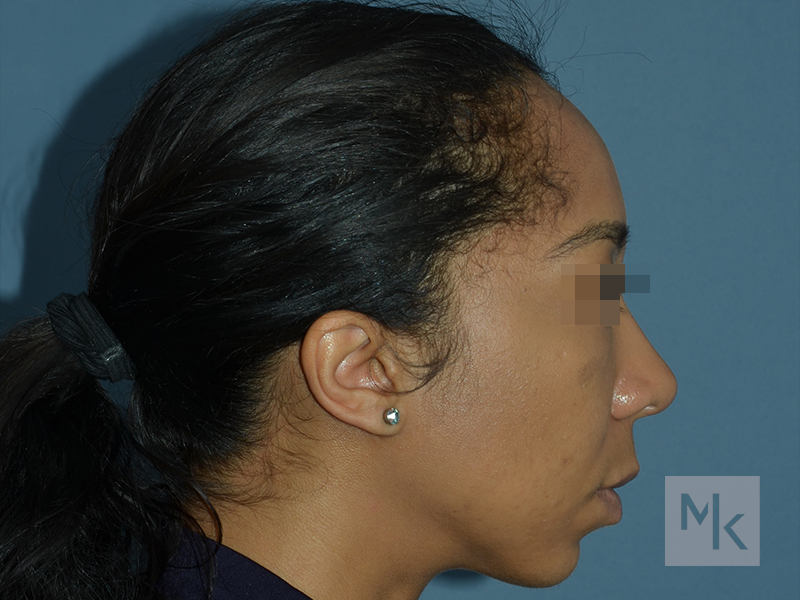 Rhinoplasty Before and After | Dr. Michael Kim