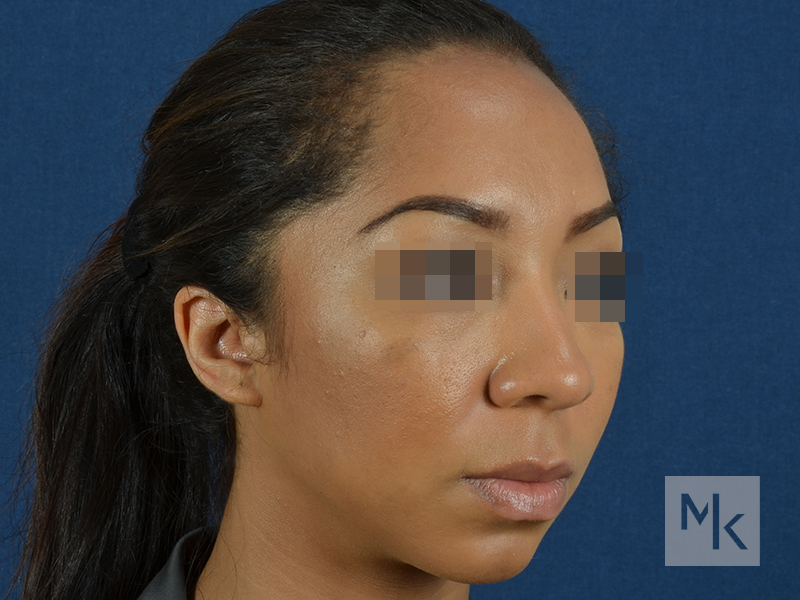 Rhinoplasty Before and After | Dr. Michael Kim