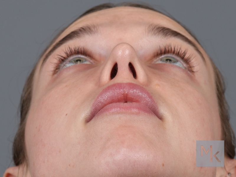 Rhinoplasty Before and After | Dr. Michael Kim