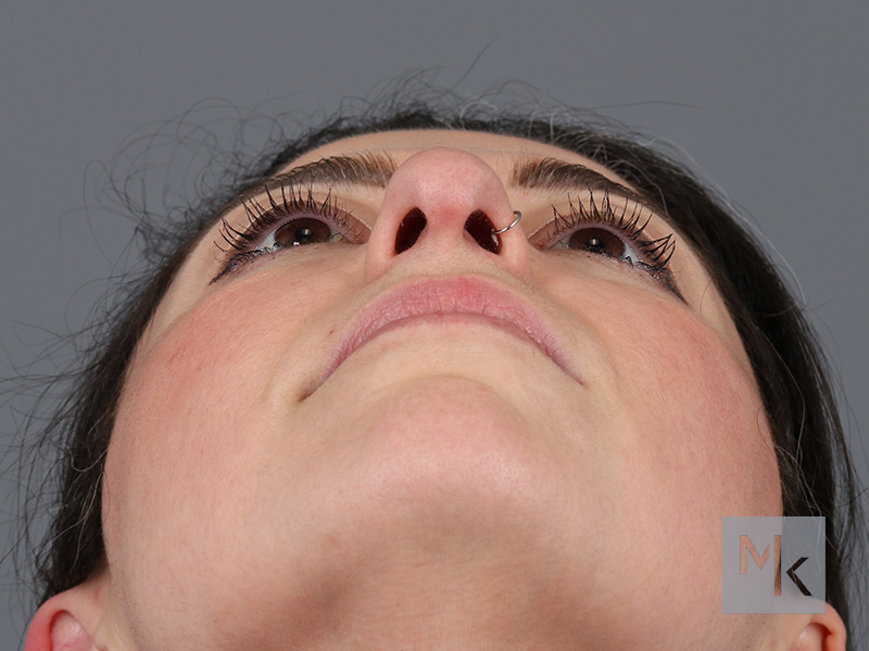 Rhinoplasty Before and After | Dr. Michael Kim