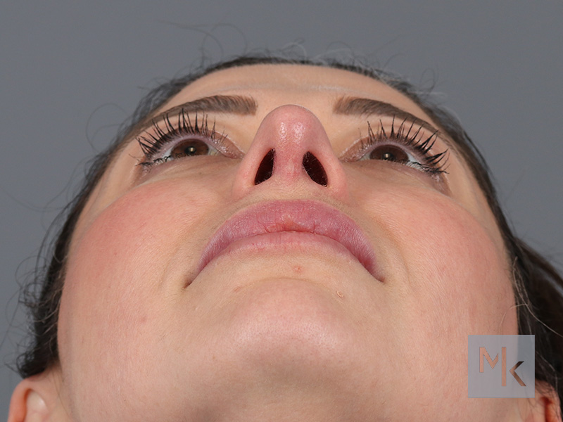 Rhinoplasty Before and After | Dr. Michael Kim