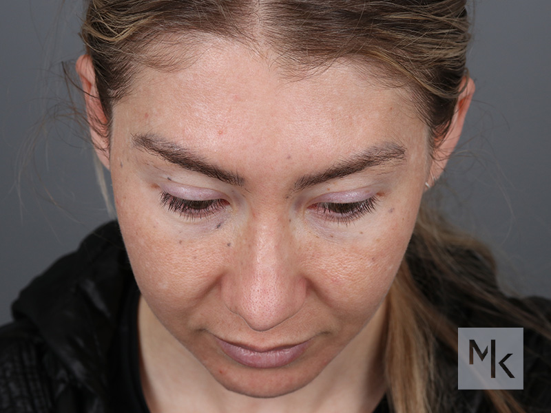 Rhinoplasty Before and After | Dr. Michael Kim