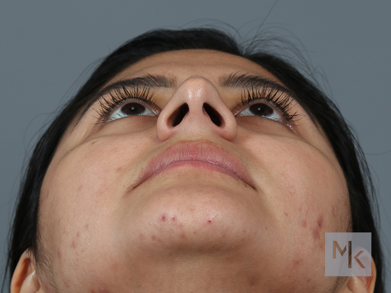 Rhinoplasty Before and After | Dr. Michael Kim