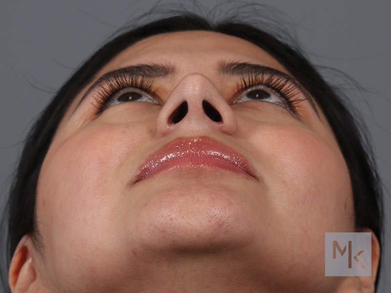 Rhinoplasty Before and After | Dr. Michael Kim