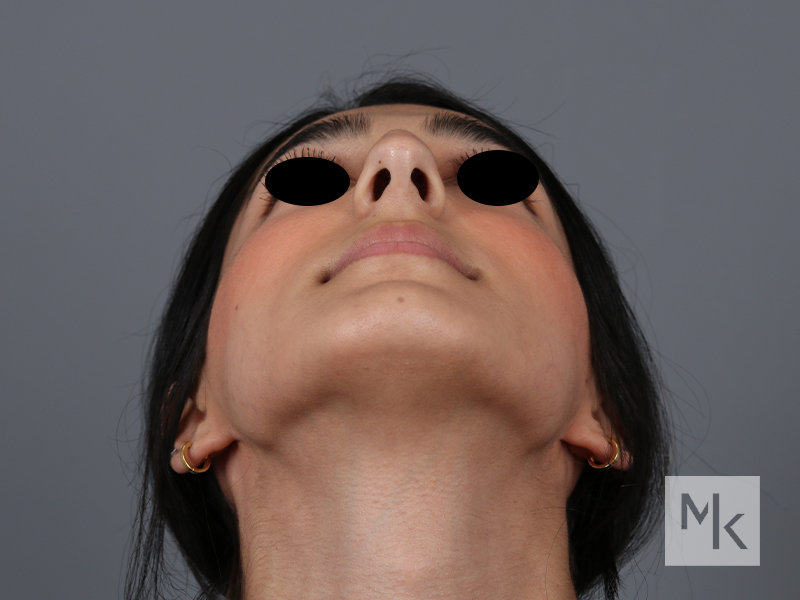 Rhinoplasty Before and After | Dr. Michael Kim