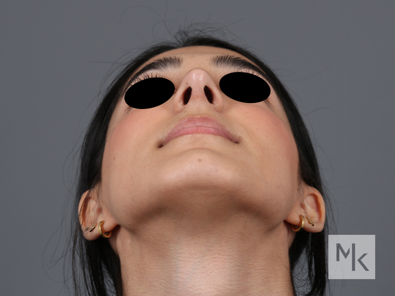 Rhinoplasty Before and After | Dr. Michael Kim