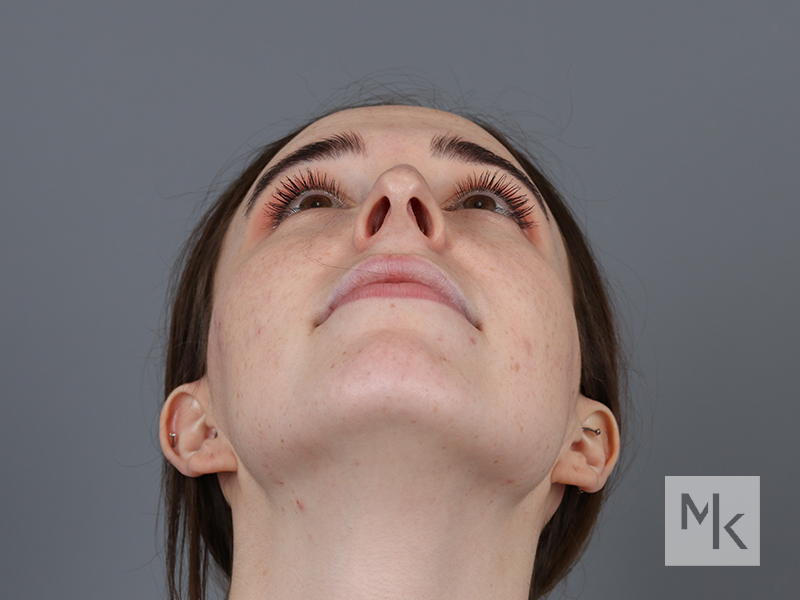 Rhinoplasty Before and After | Dr. Michael Kim