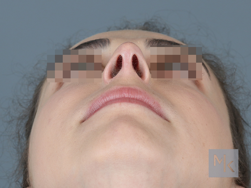 Rhinoplasty Before and After | Dr. Michael Kim