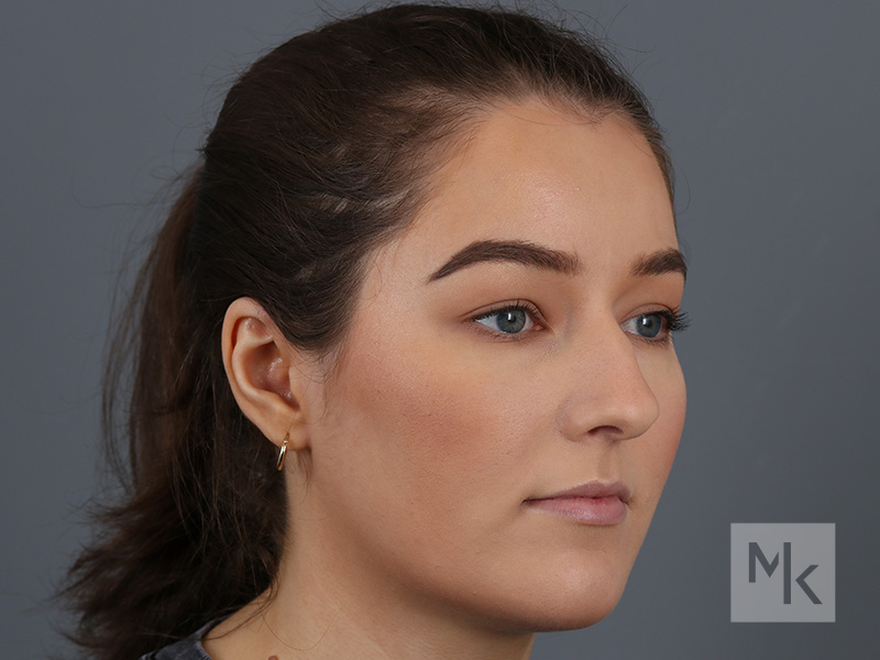 Rhinoplasty Before and After | Dr. Michael Kim