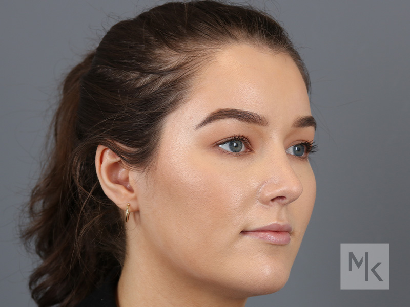 Rhinoplasty Before and After | Dr. Michael Kim