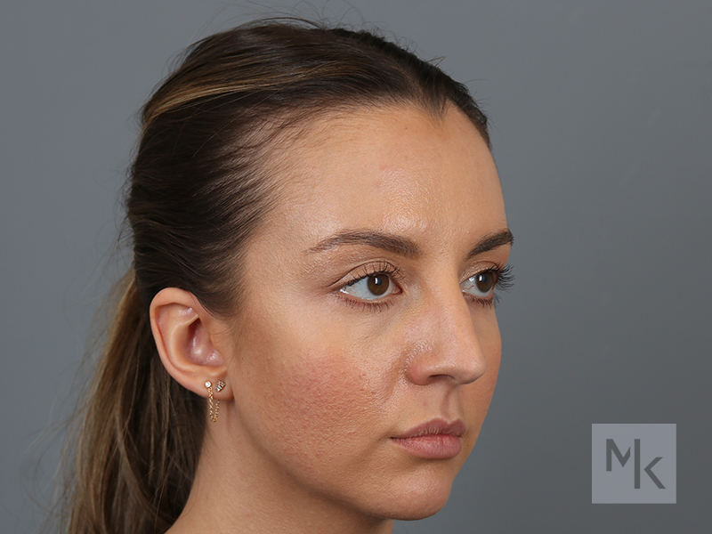 Rhinoplasty Before and After | Dr. Michael Kim