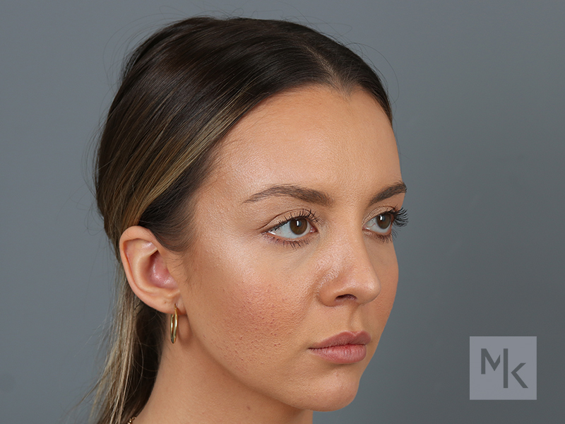 Rhinoplasty Before and After | Dr. Michael Kim