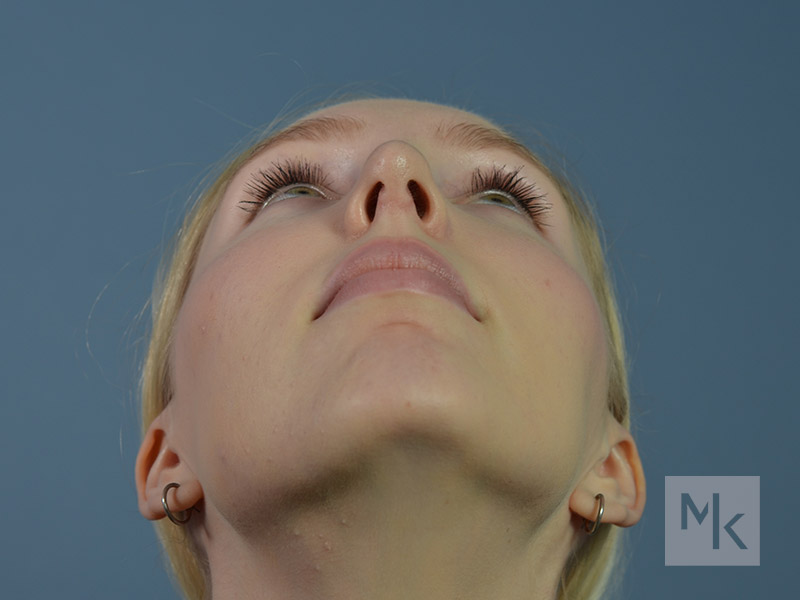 Rhinoplasty Before and After | Dr. Michael Kim