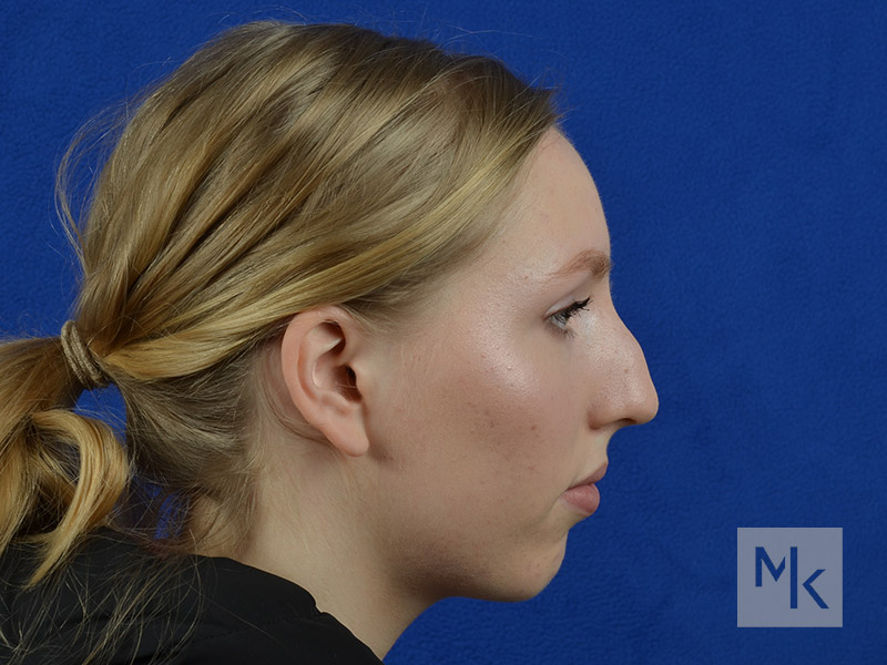 Rhinoplasty Before and After | Dr. Michael Kim