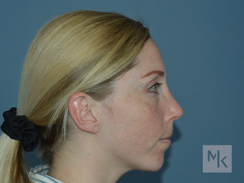 Rhinoplasty Before and After | Dr. Michael Kim