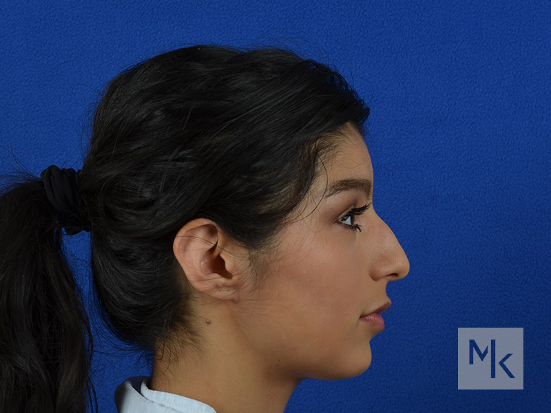 Rhinoplasty Before and After | Dr. Michael Kim