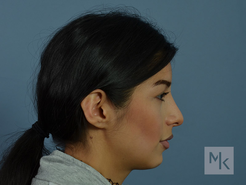 Rhinoplasty Before and After | Dr. Michael Kim