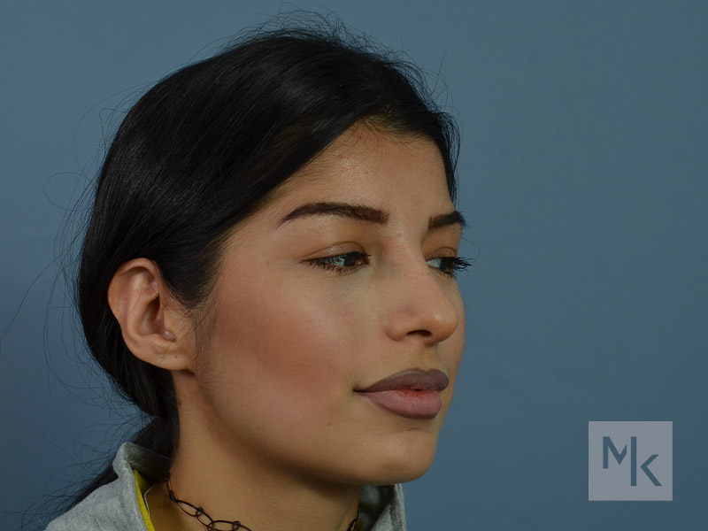 Rhinoplasty Before and After | Dr. Michael Kim