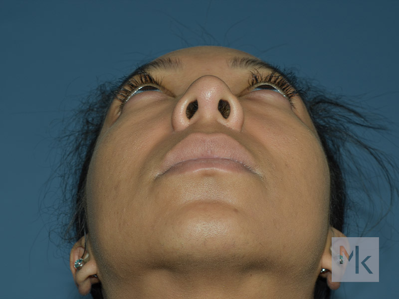 Rhinoplasty Before and After | Dr. Michael Kim