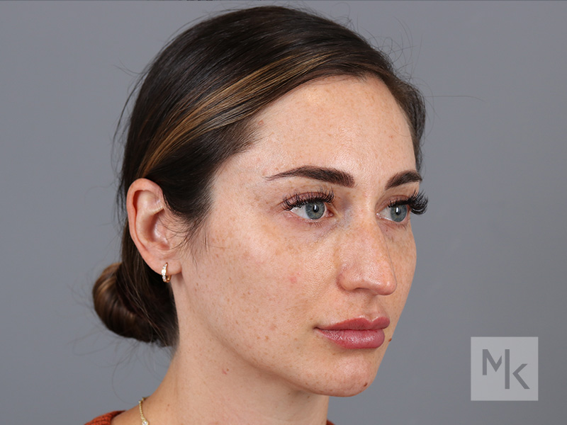 Rhinoplasty Before and After | Dr. Michael Kim